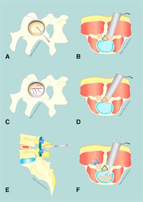 Clinical Evaluation of Paraspinal Mini-Tubular Lumbar Decompression and Minimally Invasive Transforaminal Lumbar Interbody Fusion for Lumbar Spondylolisthesis Grade I with Lumbar Spinal Stenosis: A Cohort Study
